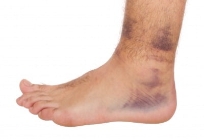 damage to feet,legs and nerves due to diabetes