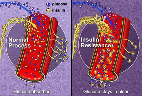 illustration of insulin resistance in type2 diabetes